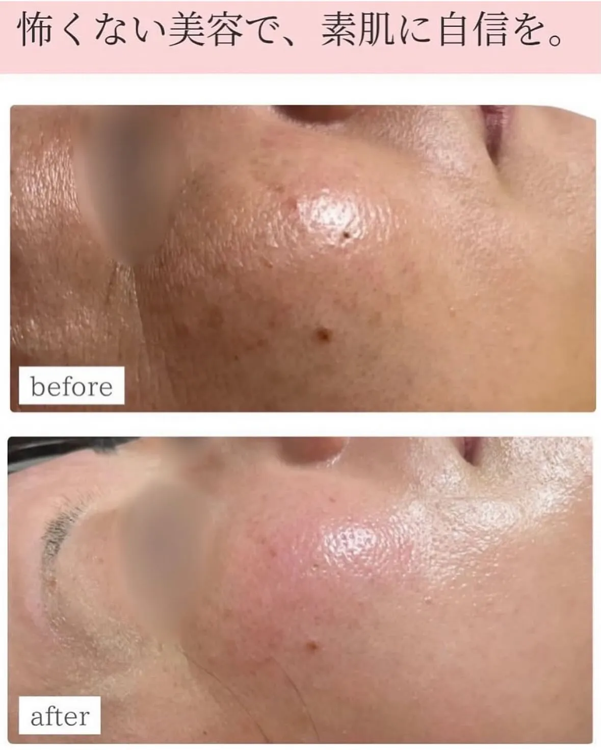 メソスキンカラー、導入しました！！